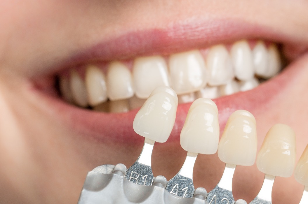 Zahnarzt, der anhand einer Farbskala am Mund einer Frau die Verblendung überprüft