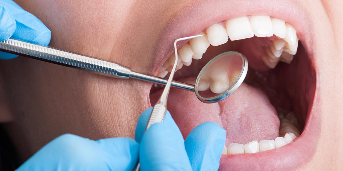 Zahnarzt kontrolliert die Zähne auf Karies
